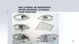 UNI LATERAL RE ESOTROPIA:
AFTER UNCOVER, LE AGAIN
TAKE FIXATION
Optom. Ankit Varshney 29
 