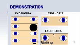 ESOPHORIAEXOPHORIA.
DEMONSTRATION
Optom. Ankit Varshney 31
EXOPHORIA
 