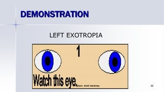 LEFT EXOTROPIA
DEMONSTRATION
Optom. Ankit Varshney 33
 