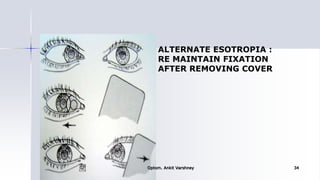 ALTERNATE ESOTROPIA :
RE MAINTAIN FIXATION
AFTER REMOVING COVER
Optom. Ankit Varshney 34
 