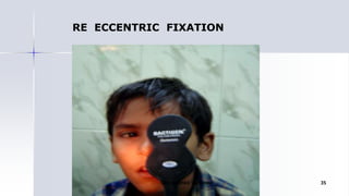 RE ECCENTRIC FIXATION
Optom. Ankit Varshney 35
 