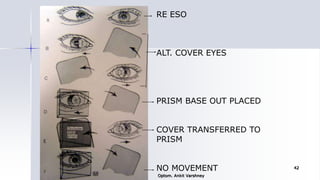RE ESO
ALT. COVER EYES
PRISM BASE OUT PLACED
COVER TRANSFERRED TO
PRISM
NO MOVEMENT
Optom. Ankit Varshney
42
 