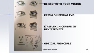 RE ESO WITH POOR VISION
PRISM ON FIXING EYE
K’REFLEX IN CENTRE IN
DEVIATED EYE
OPTICAL PRINCIPLE
Optom. Ankit Varshney 45
 