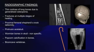 RADIOGRAPHIC FINDINGS:
Thin cortices of long bones due to
generalised osteopenia.
Fractures at multiple stages of
healing.
Proximal femoral shepherd’s crook
deformity.
Protrusio acetabuli.
Wormian bones in skull - non specific.
Popcorn calcification in bones.
Biconcave vertebrae.
 