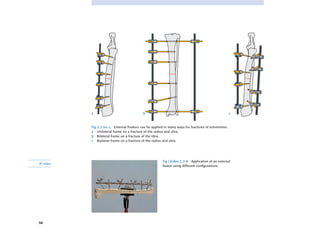 Screws and plates used in orthopaedic trauma fixation | PDF