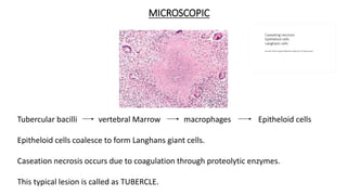 MICROSCOPIC
Tubercular bacilli vertebral Marrow macrophages Epitheloid cells
Epitheloid cells coalesce to form Langhans giant cells.
Caseation necrosis occurs due to coagulation through proteolytic enzymes.
This typical lesion is called as TUBERCLE.
 