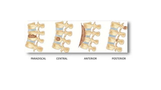 PARADISCAL CENTRAL ANTERIOR POSTERIOR
 