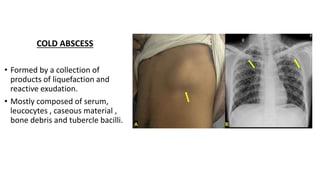 COLD ABSCESS
• Formed by a collection of
products of liquefaction and
reactive exudation.
• Mostly composed of serum,
leucocytes , caseous material ,
bone debris and tubercle bacilli.
 