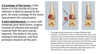 3.Curettage of the lesion:- If the
lesion is in the vicinity of a joint,
infection is likely to spread to the
joint. An early curettage of the lesion
may prevent this complication.
4.Joint debridement:- In cases with
moderate joint destruction, surgical
removal of infected and necrotic
material from the joint may be
required. This helps in the early
healing of the disease, and thus
promotes recovery of the joint.
The diagrammatic drawing of curettage combined with
resection: (a) Indications: with an extensive lesion, with around
soft tissue mass, the part broken cortical bone without possibl
of reserve, with a tumor involved the articular cavity or cruciat
ligament. (b) To remove the cortical bone and soft tissue mass
without possible of reserve, and continued to dispose the
tumor cavity using curette and a high-speed burr. (c) To fill the
cavitary bone defects with allogenic particle bone graft, and
internal fixation using an anatomical bone plate
 