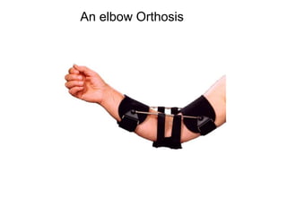 An elbow Orthosis
 