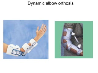 Dynamic elbow orthosis
 