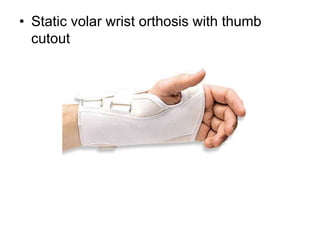 • Static volar wrist orthosis with thumb
cutout
 