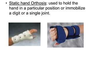 • Static hand Orthosis: used to hold the
hand in a particular position or immobilize
a digit or a single joint.
 
