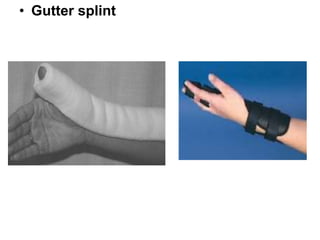 • Gutter splint
 