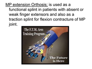 MP extension Orthosis; is used as a
functional splint in patients with absent or
weak finger extensors and also as a
traction splint for flexion contracture of MP
joint.
 