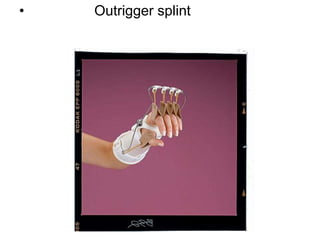 • Outrigger splint
 