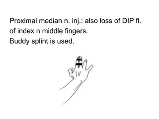 Proximal median n. inj.: also loss of DIP fl.
of index n middle fingers.
Buddy splint is used.
 
