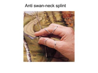 Anti swan-neck splint
 