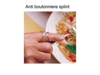 Anti boutonniere splint
 