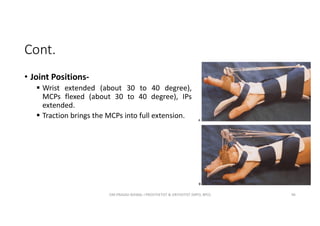 Cont.
• Joint Positions-
 Wrist extended (about 30 to 40 degree),
MCPs flexed (about 30 to 40 degree), IPs
extended.
 Traction brings the MCPs into full extension.
OM PRASAD BISWAL I PROSTHETIST & ORTHOTIST (MPO, BPO) 96
 
