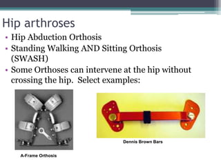 Hip arthroses
• Hip Abduction Orthosis
• Standing Walking AND Sitting Orthosis
(SWASH)
• Some Orthoses can intervene at the hip without
crossing the hip. Select examples:
Dennis Brown Bars
A-Frame Orthosis
 