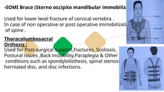Part 04
-SOMI Brace (Sterno occipito mandibular immobilization)
Used for lower level fracture of cervical vertebra .
In case of non operative or post operative immobilization
of spine .
Thoracolumbosacral
Orthosis :
Used for Post-surgical support,fractures, Scoliosis,
Postural issues ,Back instability,Paraplegia & Other
conditions such as spondylolisthesis, spinal stenosis,
herniated disc, and disc infections.
 
