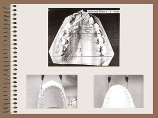 Pont Model Analysis Inference Orthodontic Study Model Analysis | PPT