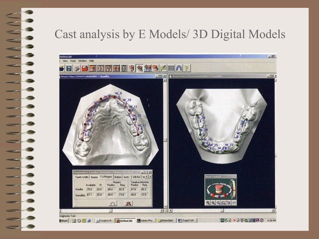 Orthodontic Study Model Analysis | PPT | Dental Health | Diseases and ...