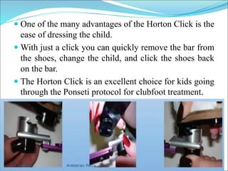  One of the many advantages of the Horton Click is the
ease of dressing the child.
 With just a click you can quickly remove the bar from
the shoes, change the child, and click the shoes back
on the bar.
 The Horton Click is an excellent choice for kids going
through the Ponseti protocol for clubfoot treatment.
Aratatran Patra
11.02.2022
 