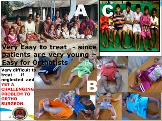 Very difficult to
treat - if
neglected and
YET A
CHALLENGING
PROBLEM TO
ORTHO
SURGEON.
Very Easy to treat - since
patients are very young –
Easy for Orthotists
A C
B
Aratatran Patra
11.02.2022
 