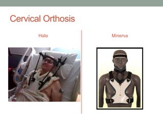 Cervical Orthosis
       Halo         Minerva
 
