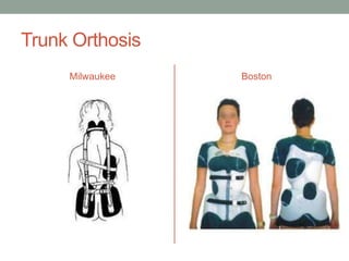 Trunk Orthosis
     Milwaukee   Boston
 