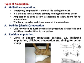 Types of Amputation:
A. Guillotine amputation.
• Emergency amputation is done as life saving measure.
• It is the one in case where primary healing unlikely to occur.
• Amputation is done as low as possible to allow room for re-
amputation.
• The bone, muscles and skin are cut at the same level.
A. Definite (classical)amputation.
• One for which no further operative procedure is expected and
prosthesis can be fitted to the patient.
A. Revision amputation.
• Done in already amputated persons. E.g. guillotine
amputation, childhood amputation etc. aiming for better
stump
 