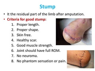 Stump
• It the residual part of the limb after amputation.
• Criteria for good stump:
1. Proper length.
2. Proper shape.
3. Skin free.
4. Healthy scar.
5. Good muscle strength.
6. Joint should have full ROM.
7. No neuroma.
8. No phantom sensation or pain.
 