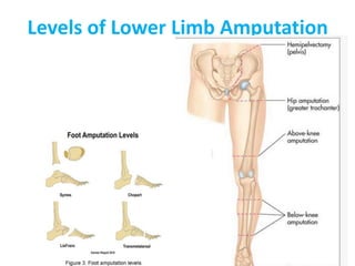Levels of Lower Limb Amputation
 
