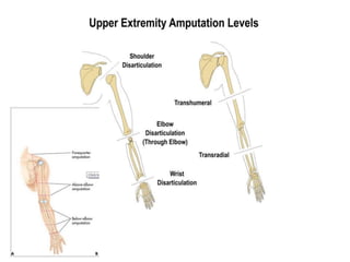 Levels of Upper Limb Amputation
 