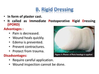 • In form of plaster cast.
• It called as Immediate Postoperative Rigid Dressing
(IPORD)
Advantages :
• Pain is decreased.
• Wound heals quickly.
• Edema is prevented.
• Prevent contractures.
• Protect from trauma.
Disadvantages:
• Require careful application.
• Wound inspection cannot be done.
 