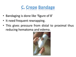 • Bandaging is done like ‘figure of 8’
• It need frequent rewrapping.
• This gives pressure from distal to proximal thus
reducing hematoma and edema.
 