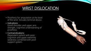 WRIST DISLOCATION
• Prosthesis for amputation at the level
of the wrist. Includes terminal device.
• Indications:
Good shoulder and upper arm
strength, cognitive understanding of
prosthesis.
• Contraindications:
Dependent patient with poor
cognition and upper extremity
weakness combined with poor
support system.
 