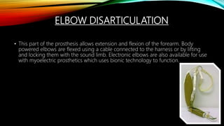 ELBOW DISARTICULATION
• This part of the prosthesis allows extension and flexion of the forearm. Body
powered elbows are flexed using a cable connected to the harness or by lifting
and locking them with the sound limb. Electronic elbows are also available for use
with myoelectric prosthetics which uses bionic technology to function.
 
