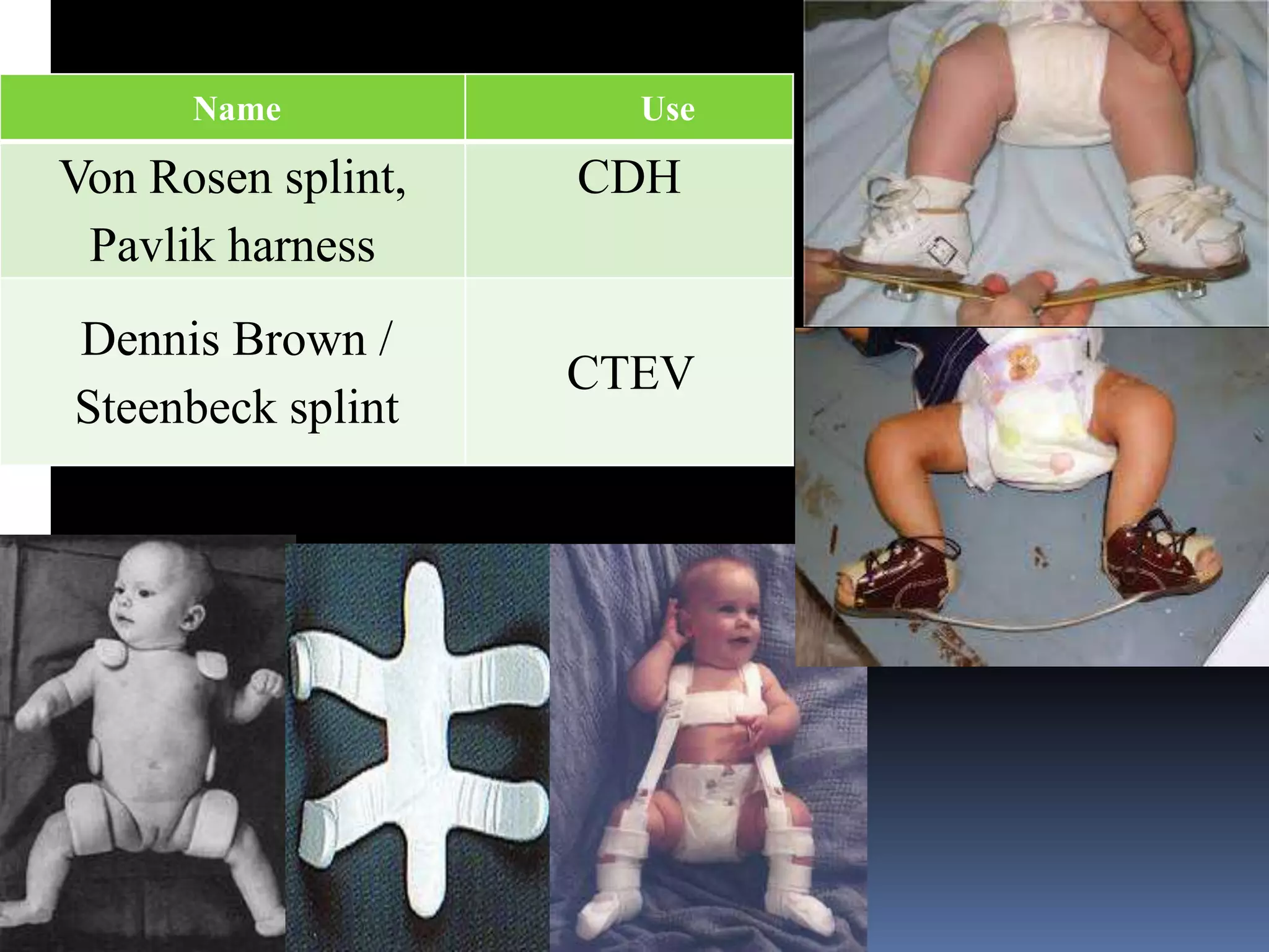Name            Use

Von Rosen splint,   CDH
 Pavlik harness
Dennis Brown /
                    CTEV
Steenbeck splint
 