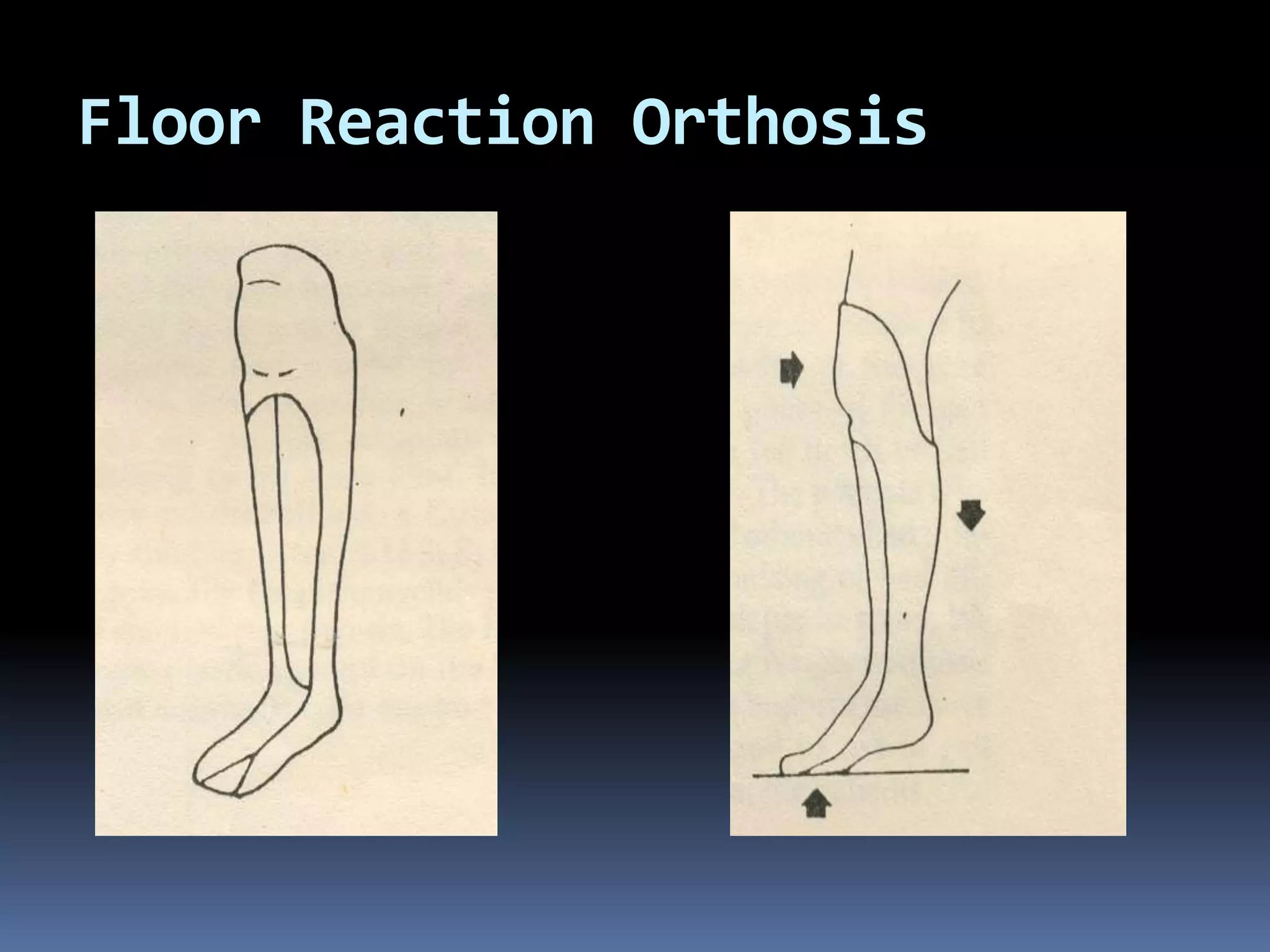 Floor Reaction Orthosis
 