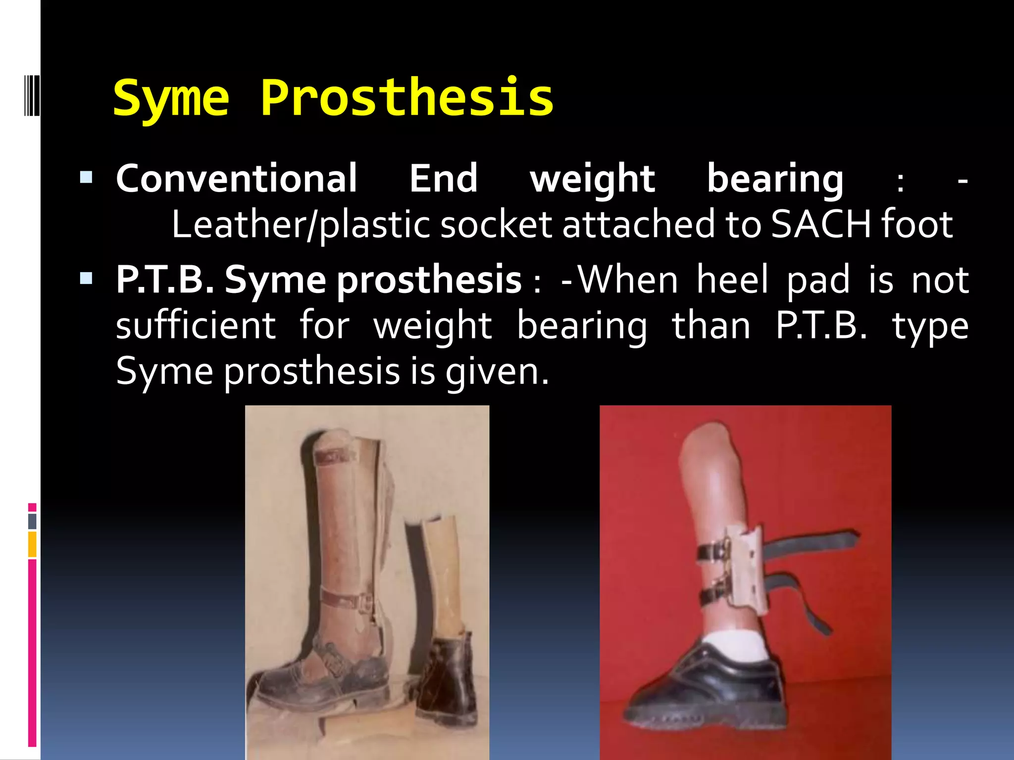 Syme Prosthesis
 Conventional     End weight bearing : -
     Leather/plastic socket attached to SACH foot
 P.T.B. Syme prosthesis : -When heel pad is not
  sufficient for weight bearing than P.T.B. type
  Syme prosthesis is given.
 