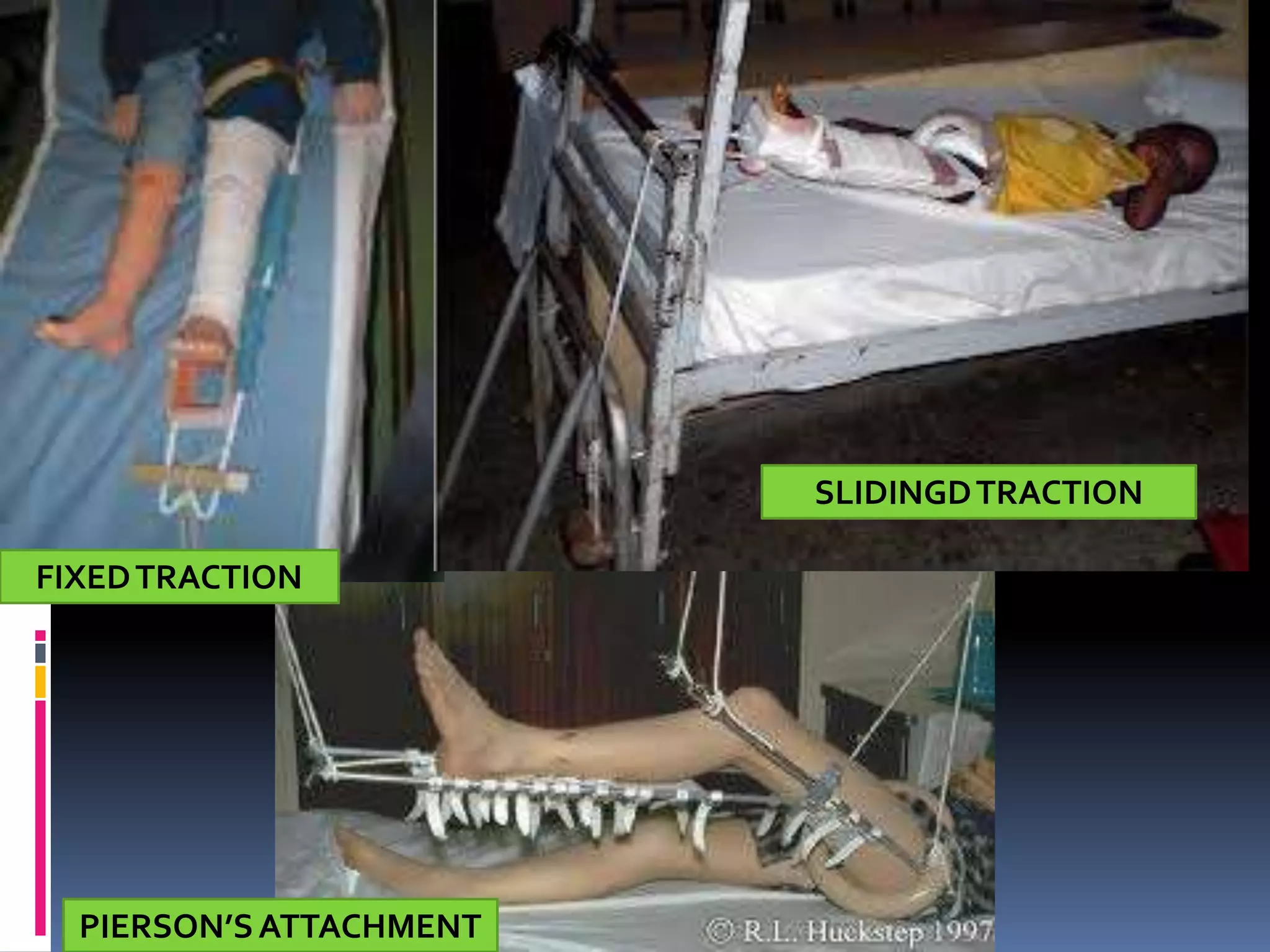 SLIDINGD TRACTION

FIXED TRACTION




  PIERSON’S ATTACHMENT
 