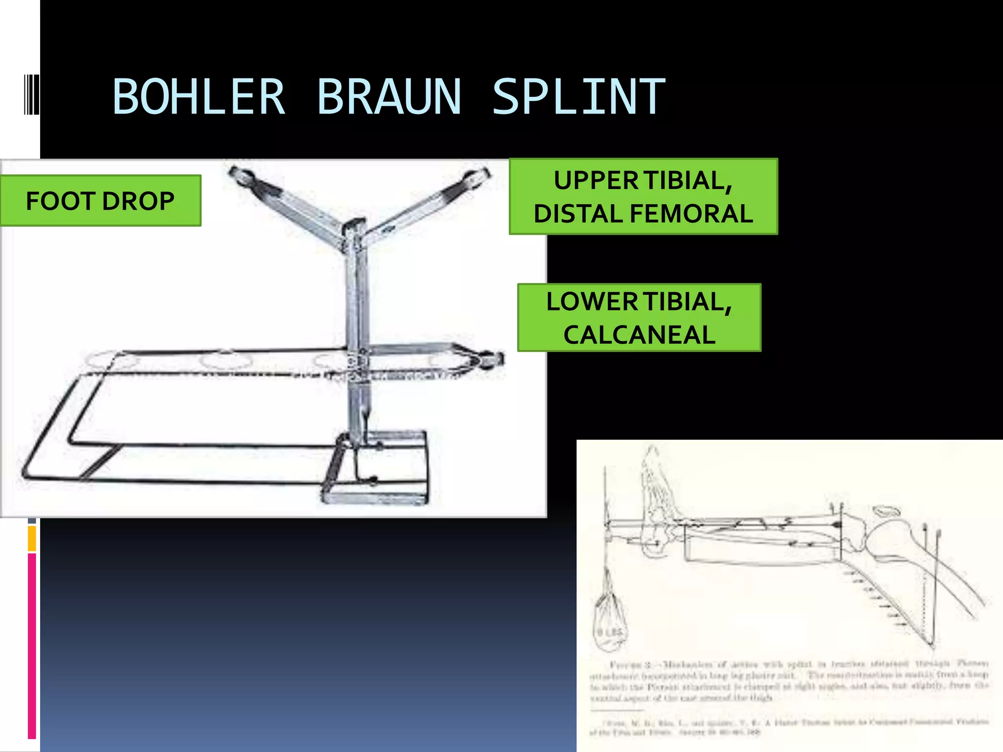 BOHLER BRAUN SPLINT
                    UPPER TIBIAL,
FOOT DROP          DISTAL FEMORAL


                   LOWER TIBIAL,
                    CALCANEAL
 