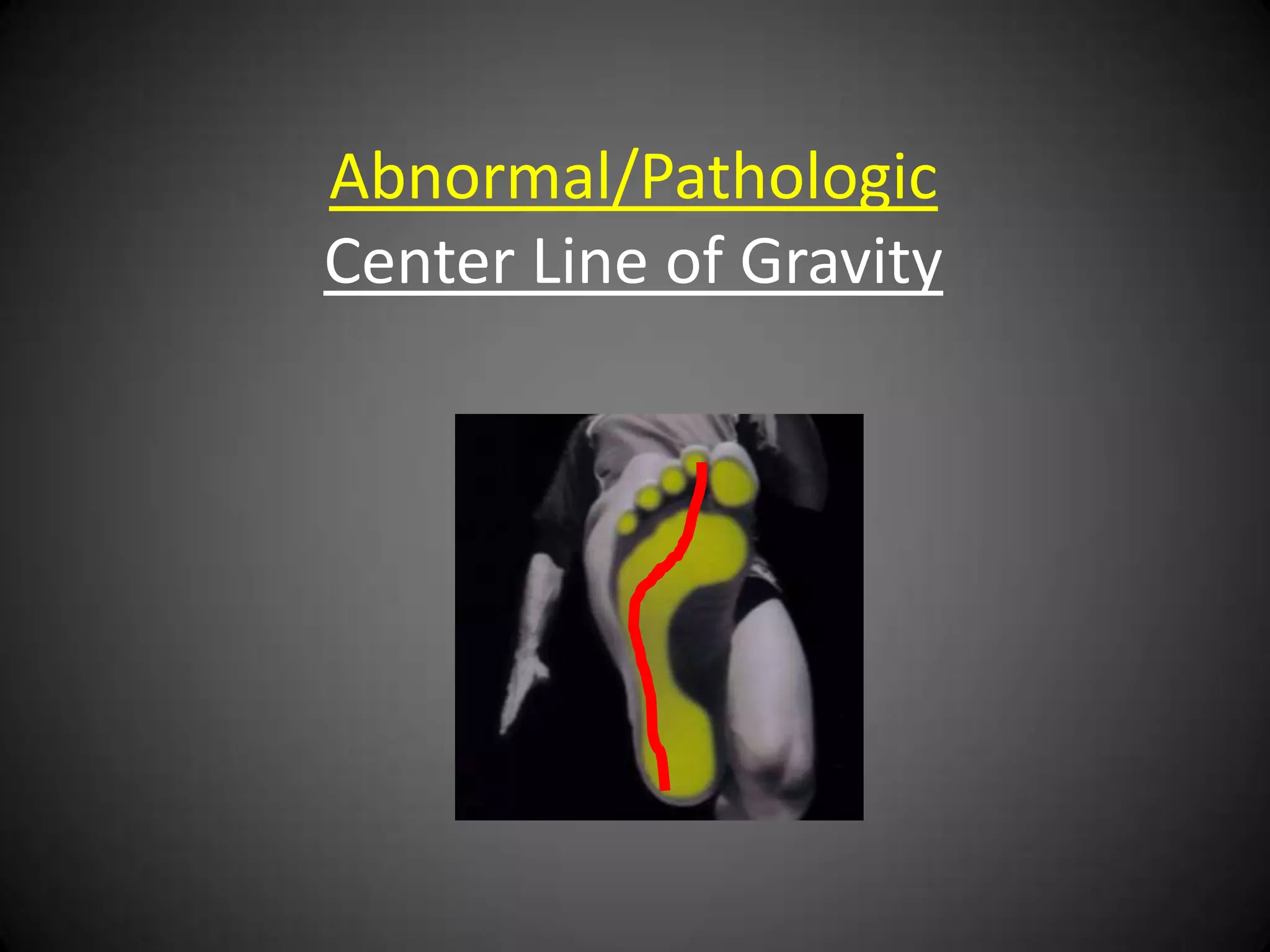Stance Phase of the Gait Cycle with
Displacement of Talotarsal Joint Mechanism
 
