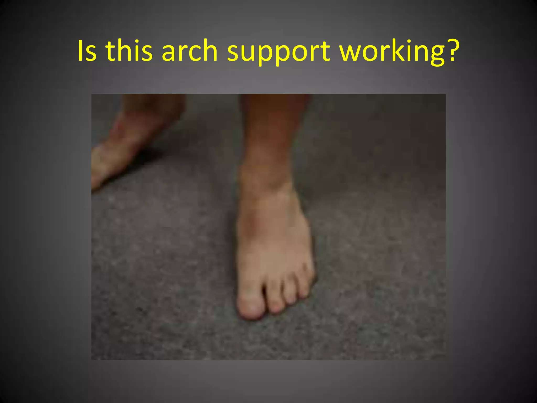 An arch support, even if custom-
made, cannot prevent/stabilize a
    talotarsal displacement.
 