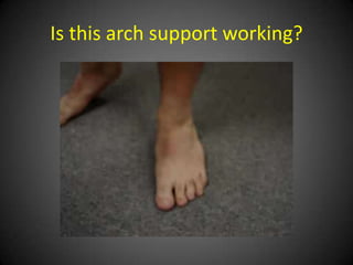 An arch support, even if custom-
made, cannot prevent/stabilize a
    talotarsal displacement.
 