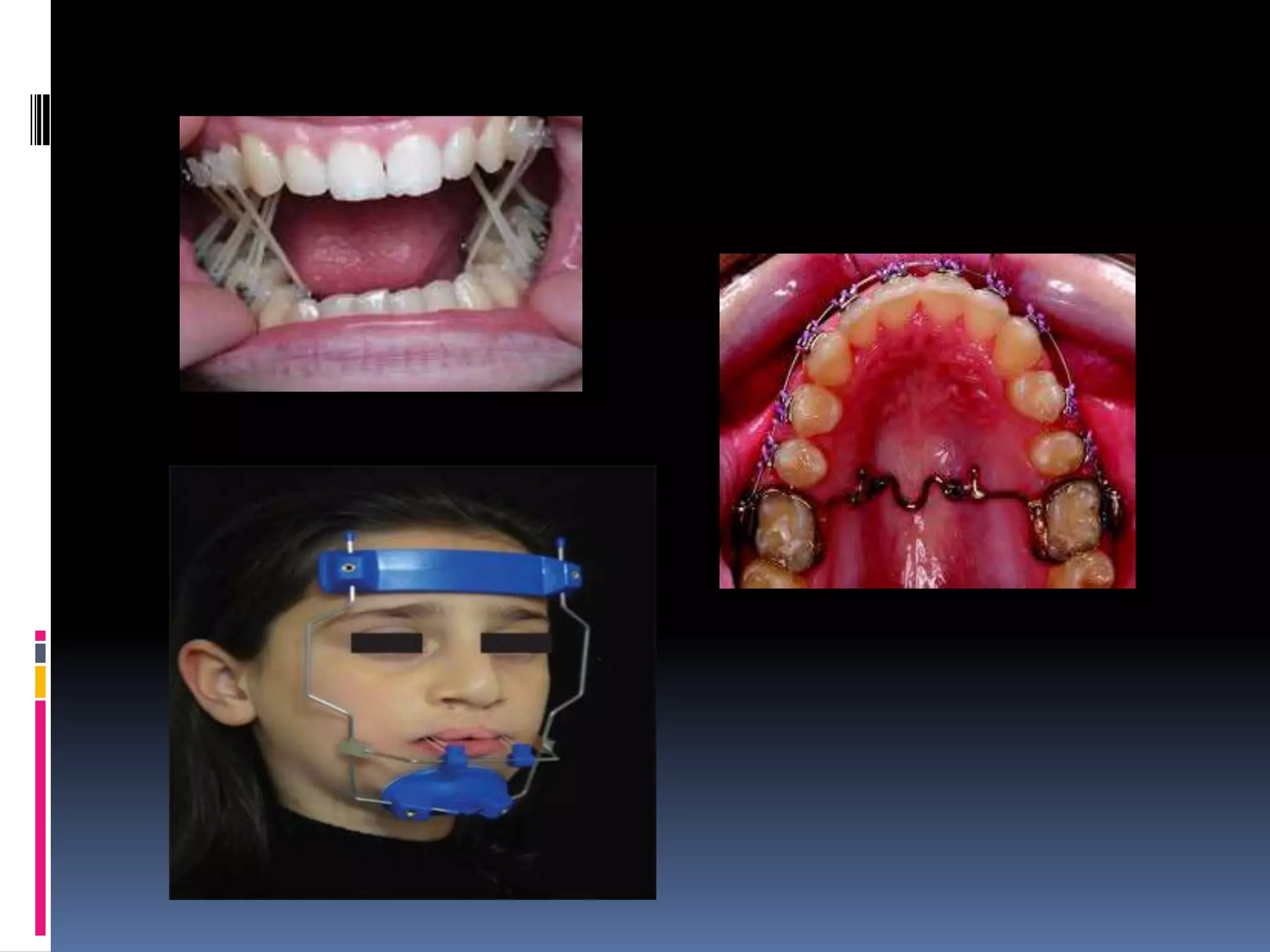 Orthodontic tooth movement ppt. | PPTX
