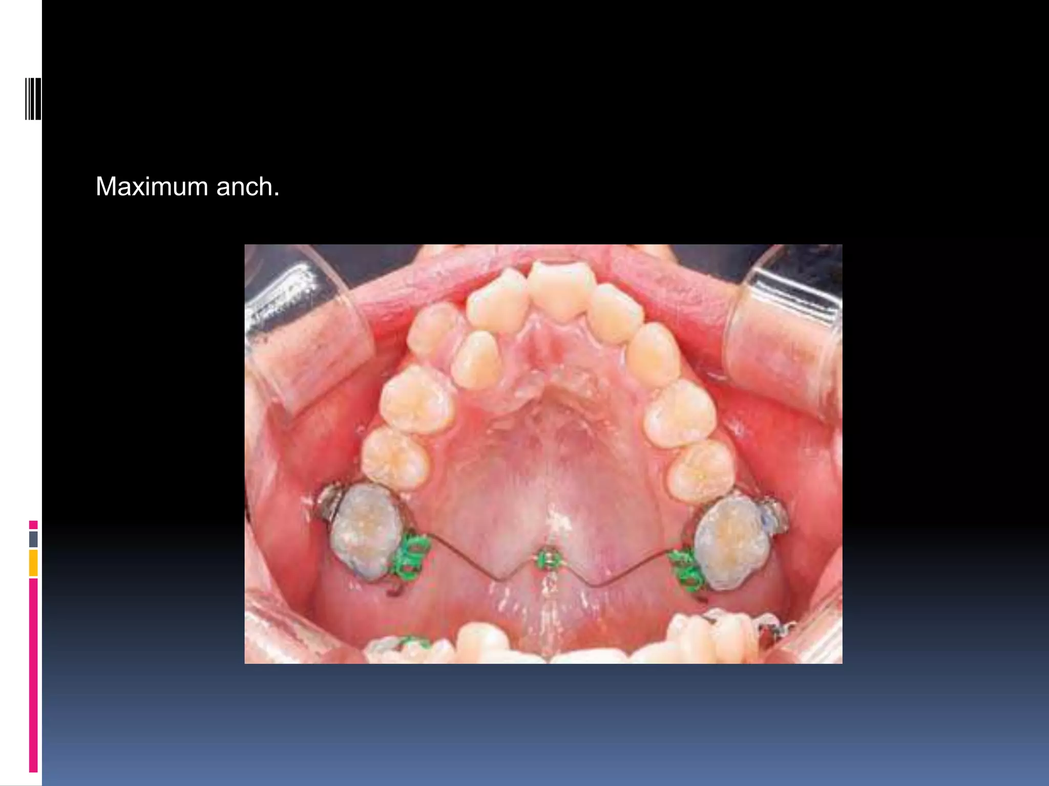 Orthodontic tooth movement ppt. | PPTX